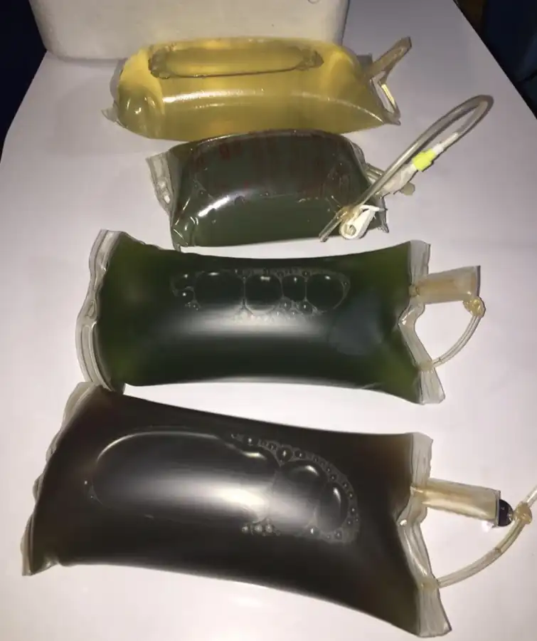 Four plasma bags with visible variations in color and appearance